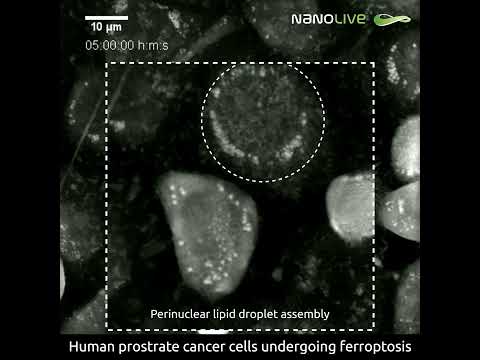 Label-free cell imaging: Prostate cancer cells undergoing ferroptosis