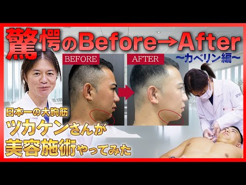 【コンプレックスを解消！】二重あご解消へ！カベリン注射 & 驚愕のビフォーアフターを大公開！！ツカケンさんが美容施術やってみた 後編！