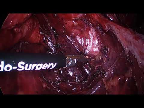 Nerve-sparing laparoscopic low anterior resection for rectal endometriosis in ten steps