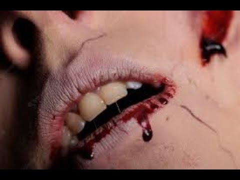 Popping huge blackheads and Pimple Popping - Best Pimple Popping Videos |20