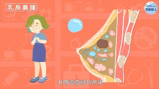 乳房有硬塊，是不是乳癌？