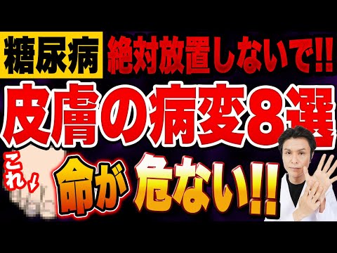 糖尿病と皮膚病変：皮膚科医が教える知っておきたい８つの症状