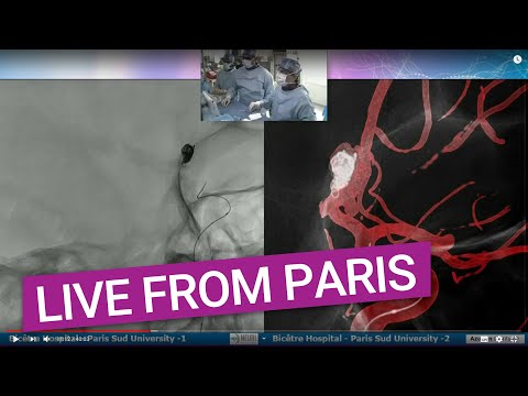 Treating a recurrence of an Acom aneurysm using flow diversion