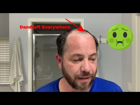 Dandruff, Hair System or Hair Replacement | What Do I Do ?