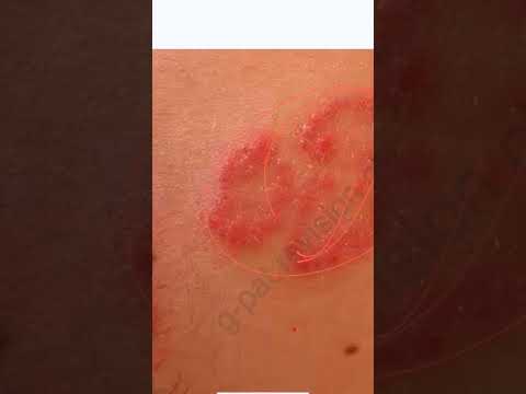 Skin infection , fungal infection #shortsyoutube #shortsviral #short @g-patrevisionclasses