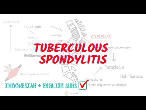 Tuberculous Spondylitis: Overview and Treatment