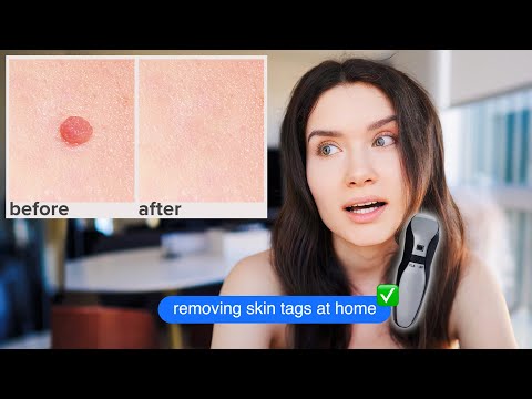 Warts and Mole Remover Pen - EFFECTIVE or NOT!? How I got rid of SKIN TAGS at HOME