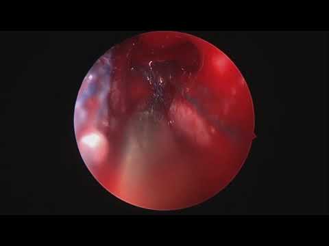 Hemorrhagic direct traumatic carotid-cavernous fistula during endoscopic transsphenoidal surgery ...