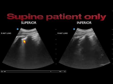 POCUS: Misdiagnosis of Pneumothorax