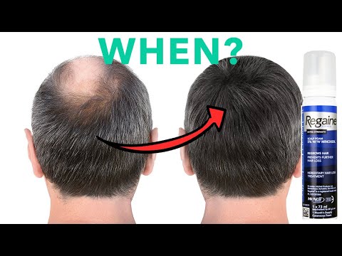 Minoxidil Results - What To Expect - How long does it take?