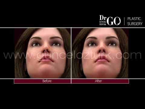 Opération de rhinoplastie avec technique de préservation du nez "Let Down & Push Down Güncel Öztürk