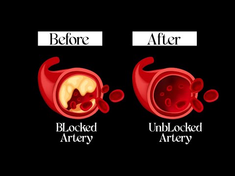 How to Lower Cholesterol Naturally? Foods to Help Lower LDL (Bad) Cholesterol