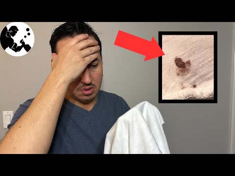 How To Remove Blood Stains From Clothes! 🩸