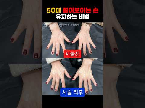 50대 마른 손등에서 젊어 보이는 손등으로 유지하는 비법 | 손등필러 손등관리 리쥬란 filler