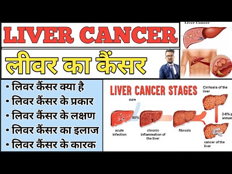 Liver Cancer | लिवर कैंसर | Liver Cancer Symptoms | Liver Cancer Notes | Liver Cancer Treatment