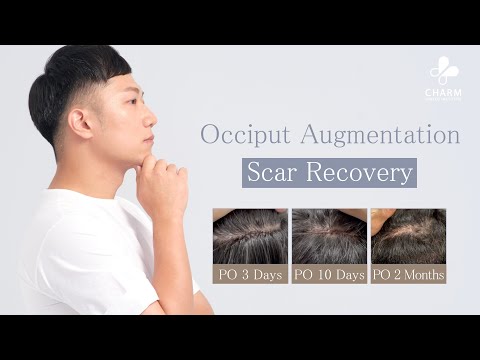 Occiput Augmentation｜The Scar After Recovery