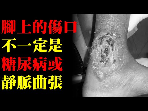 腳上的慢性傷口，不一定是糖尿病或靜脈曲張｜許原彰醫師：高雄，台南，屏東，台中靜脈曲張專科