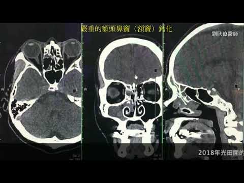 70° Endoscopic Frontal Sinus Surgery (Medical Education)