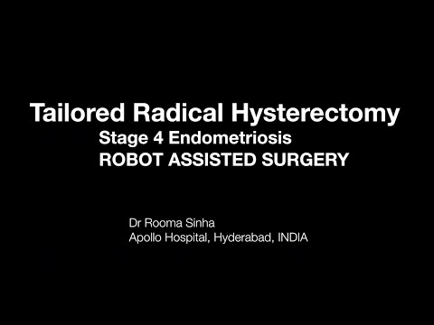 ROBOTIC Hysterectomy FOR STAGE 4 ENDOMETRIOSIS ROOMA SINHA Apollo Hospital