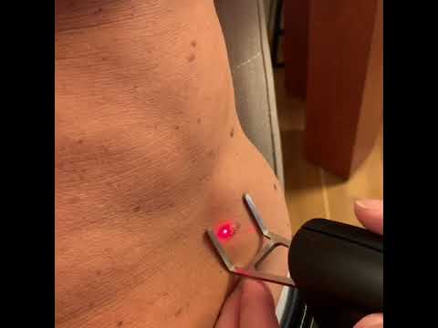 Seborrheic Keratosis Removal by MedArt FRx Intenz CO2 Laser