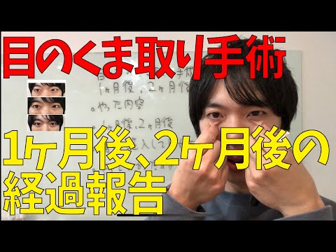 目の下の切らないクマ取り手術をした1ヶ月後、2ヶ月後の経過を紹介。くま取り治療。術後ダウンタイム