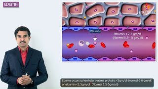 1.Edema introduction - Hemodynamic pathology Fmge, Neet PG and  usmle