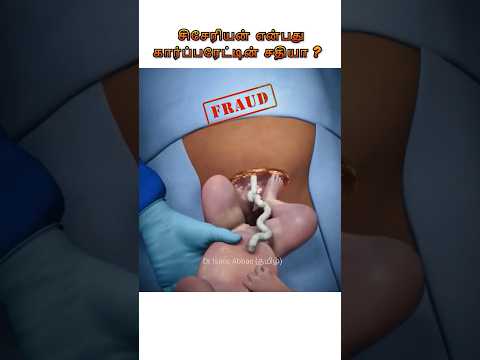 சிசேரியன் என்பது கார்ப்பரேட்டின் சதியா ? Is Caesarean procedure a scam?  Dr. Isacc Abbas