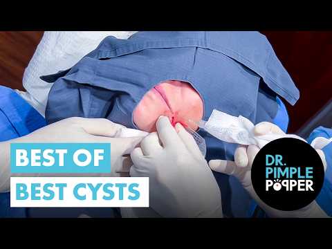 Dr Pimple Popper’s BEST OF THE BEST CYSTS!