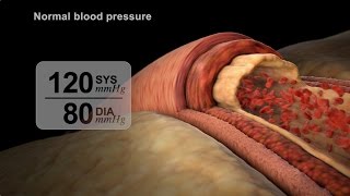 High Blood Pressure Diagnosis | NUCLEUS Medical Media