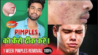 Pimple को कैसे ठीक करे | How to Remove Pimples & Acne Naturally at Home Skin Care Routine Tips Hindi