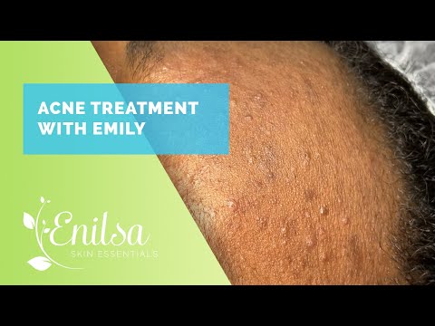 Acne Treatment & Extractions on Emily - New Patient!