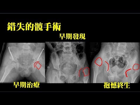 什麼是「股骨頭缺血性壞死」？