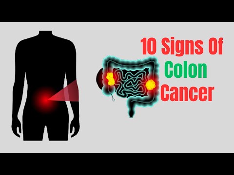 Top 10 Early Warning Signs Of Colon Cancer – Colon Cancer signs