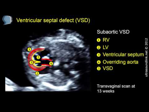 Ventricular septal defect (VSD) - difficult diagnosis