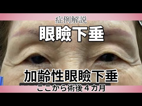 眼瞼下垂完成。眼瞼下垂手術の症例解説　名古屋こいずみ形成クリニック