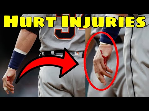 MLB | Creepy Injuries 3