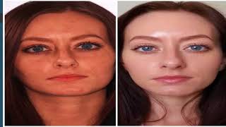 Pigmentation Spot Removal in Delhi-youthologyclinic.com