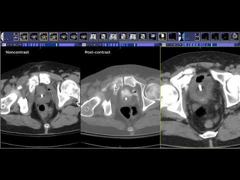 How to read a CT Cystogram