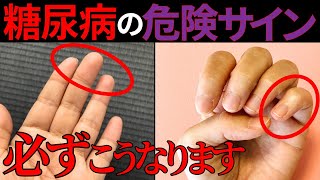 【医師監修】絶対に見逃してはいけない「糖尿病の手からの危険サイン」症状から予防法まで徹底解説