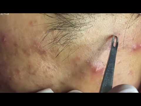 Huge Blackhead Extraction | Milia | Blackhead Removal