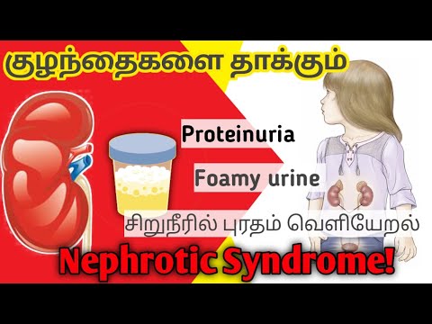 Nephrotic syndrome in tamil/nephrotic syndrome symptoms in tamil/nephrotic syndrome treatment tamil