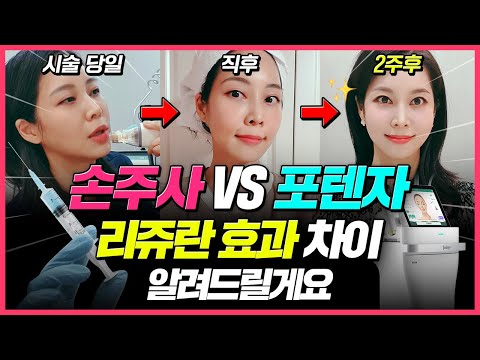 [리쥬란X포텐자] 셀프 시술 후 2주간의 리얼후기 알려드립니다! 리쥬란 시술방법 [손주사 vs 포텐자] 효과 뭐가 더 좋을까?