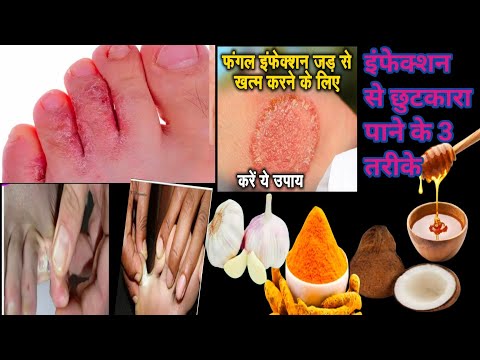 fungal infection| fungal infection treatment at home/खुजली के घरेलू -उपाय/ पैरों की सड़न/ athletfoot