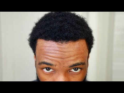 Hair Transplant Week 33