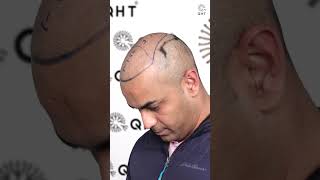 Hair Transplant Repair Case | Latest Fue Technique #shorts #viral