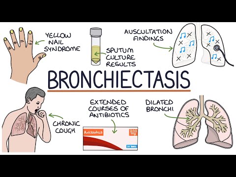 Understanding Bronchiectasis