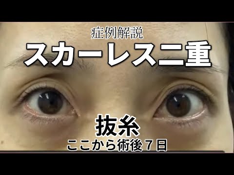 スカーレス眼瞼下垂　１週間の症例解説