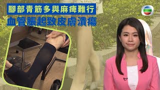 健康360 TVB｜靜脈曲張影響 腳部青筋多與麻痺難行 腳部活瓣功能失常血流過多 血管脹起致皮膚潰瘍   激光治療封閉壞血管 跑步或浸暖水紓緩靜脈曲張｜ 黃靖婷｜最強生命線