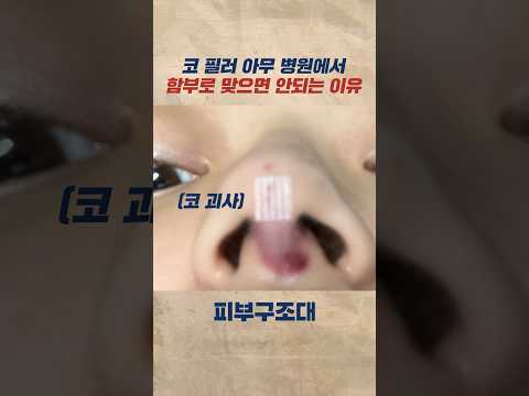 코 필러가 위험한 이유