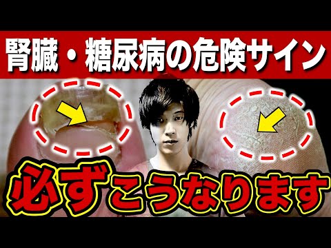 【放置厳禁】知らないと後悔する糖尿病・腎臓病『足』の危険サイン。99%の糖尿病患者に出現する【初期症状】とは？（腎臓病・糖尿病・血糖値）